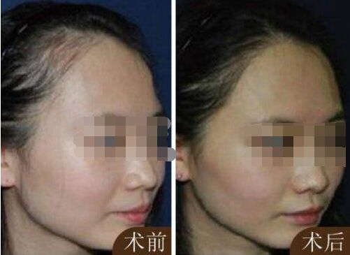 种植头发要多少钱_头发种植靠谱吗  第3张